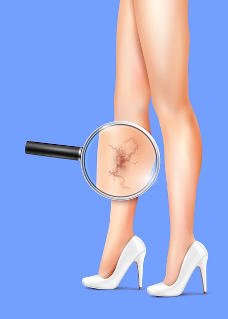 Conquer Varicose Veins: Effective Treatment Solutions