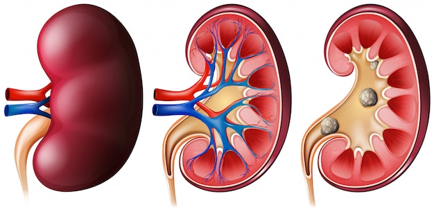 Discover the Ultimate Solution for Kidney Stone Relief