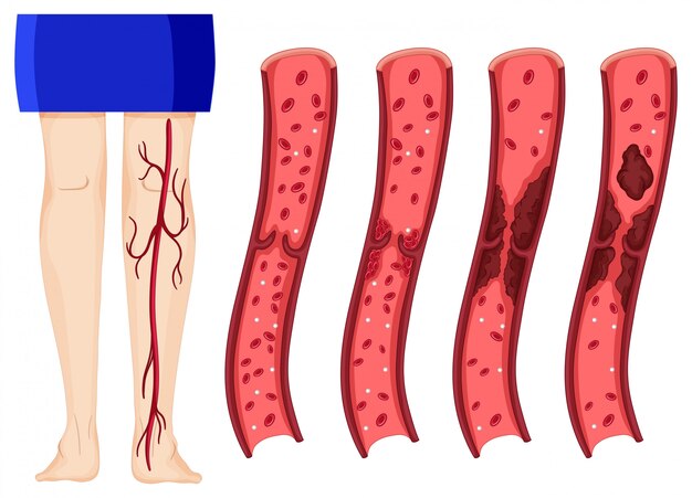 Essential Actions to Combat Deep Vein Thrombosis