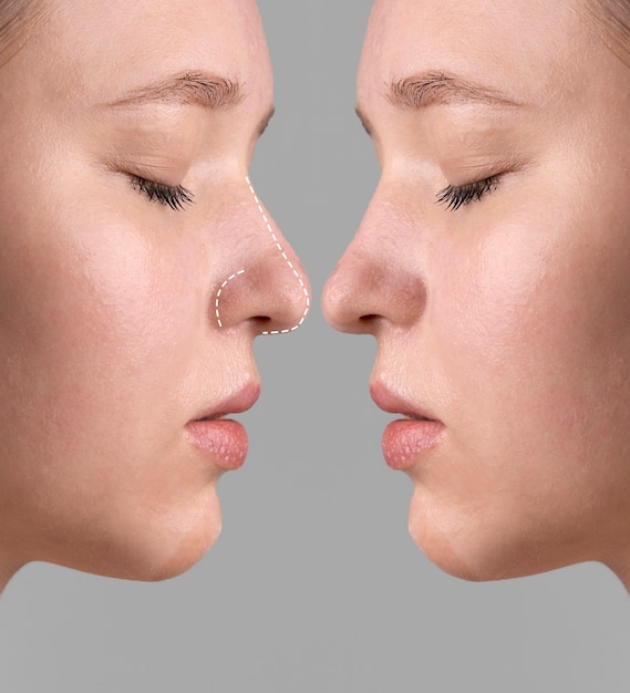 Essential Advice for a Smooth Rhinoplasty Recovery