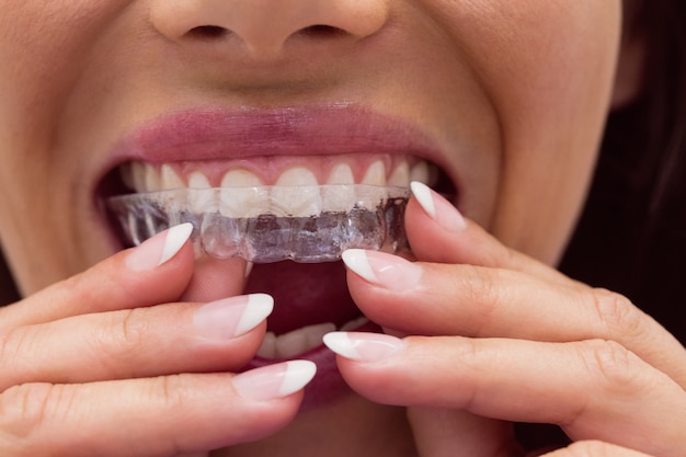 Invisalign vs. Traditional Braces: Essential Facts You Need to Know