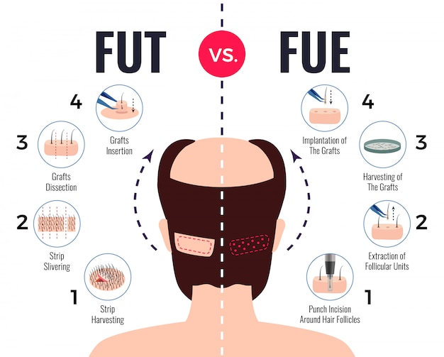 Revolutionary Advances in FUE Hair Transplant Technology