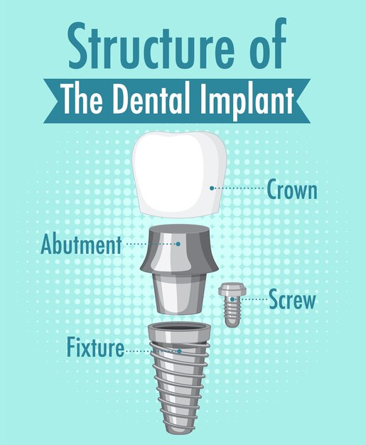 Unlock Stronger Bones and Healthier Gums with Dental Implants in Calgary